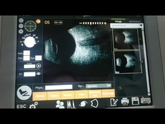 Μηχανή 10MHz ανίχνευσης ανίχνευσης Β ανεμιστήρων που παρατηρεί την αμφιβληστροειδική αποσύνδεση