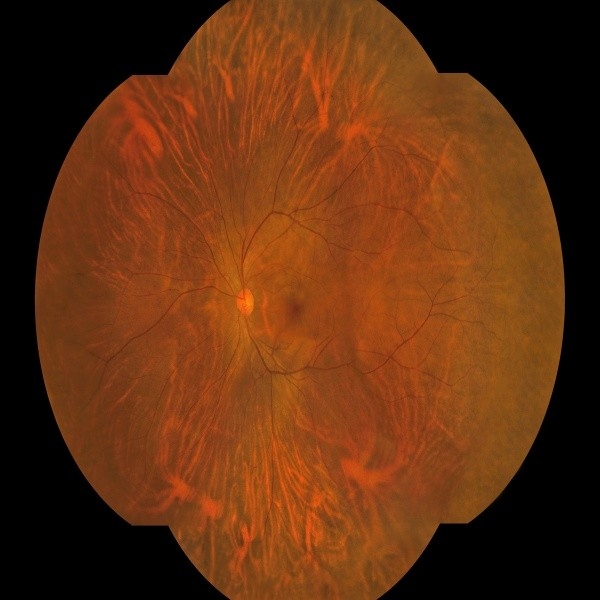 176 βαθμοί Wide Angle Fundus κάμερα με ένα κλειδί λειτουργίας και διπλανή λήψη για οφθαλμικές ιατρικές συσκευές